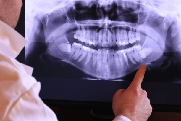 Best Emergency Dental Extractions in French Valley, CA